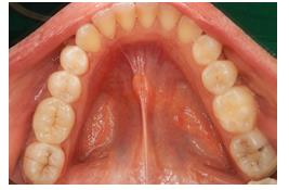 Figure 9: Final restoration after final polymerization and checking occlusal adjustment.