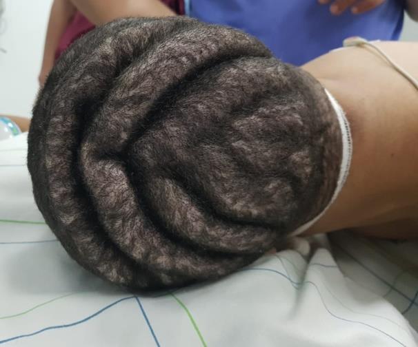 Figure 1: Clinical aspect showing large symmetrical folds affecting a large proportion of the patient’s scalp.