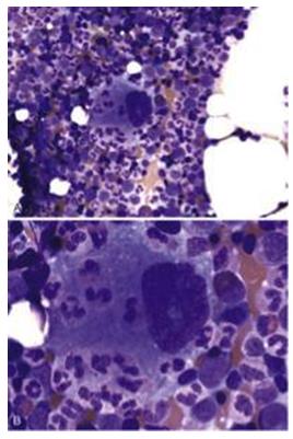 Figure 10: Hepatoblastoma showing pseudo rosettes in FNA of neonatal liver.