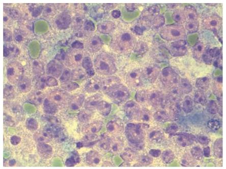 Figure 12: Classical spindle morphology of GIST.
