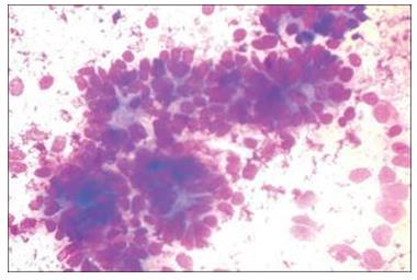 Figure 13: Liver FNA shows metastatic IDC breast and colonic carcinoma respectively.