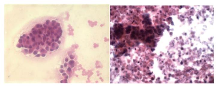 Figure 16: Extensive granulomas occupying large areas of spleen.