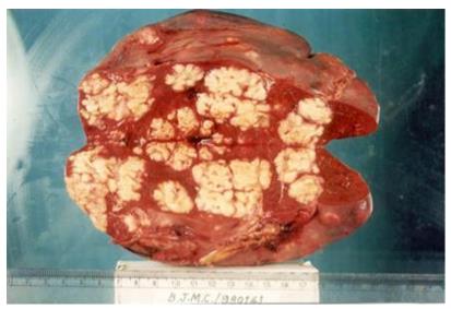 Figure 17: FNA of spleen- macrophages contain lysosomal accumulation of glucocerebroside.