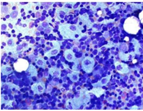Figure 19: Pseudo gaucher cells in BMA of ALL.