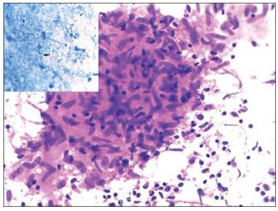 Figure 21: Splenic hamartoma.