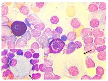 Figure 22: Splenic angiosarcoma.