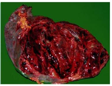 Figure 26: Serous cystadenoma cytology and corresponding histopathology.