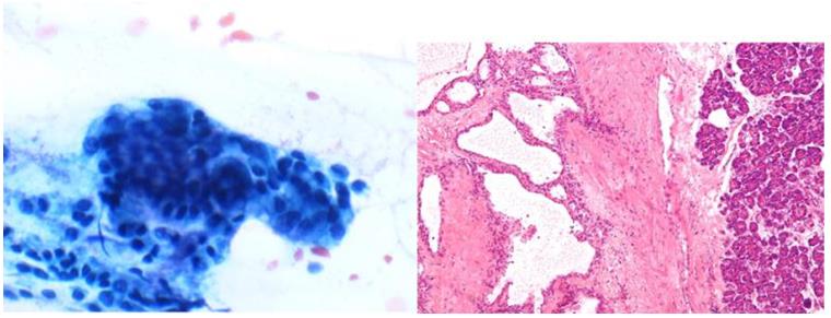 Figure 29: Cell blocks show p53 positivity and loss of nuclear SMAD4.