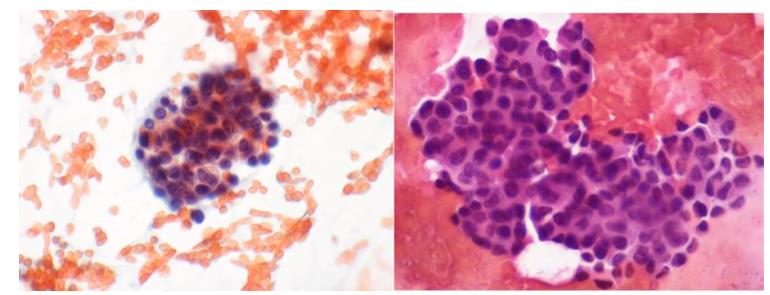 Figure 35: Well-formed epitheloid granuloma.