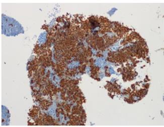 Figure 36: Aspergillus hyphae in cytology.
