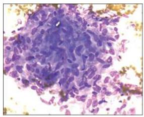 Figure 38: Asbestosis bodies.