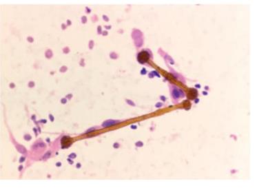Figure 42: Adenocarcinoma showing clear papillary fonts in cytology. Small cell carcinoma [43] • Small or medium-sized cells with little or no cytoplasm (larger than in sputum), • Dispersed cell presentation, • Nuclear molding and engulfment; irregular nuclei, • Uniform finely or coarsely granular nuclear chromatin;