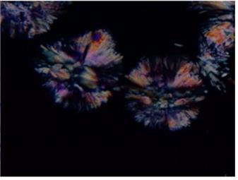 Figure 43: Above Images show powdery chromatin and small nuclei favoring small cell carcinoma. Large Cell Carcinoma • Large, highly pleomorphic cells with abundant cytoplasm, • Large multilayered fragments of malignant tissue, • Dispersed cells with a high N:C ratio, • Tumor giant cells, • Polymorph ingestion, • Fragile cytoplasm (Figure 44).