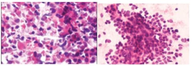 Figure 44: Large cells carcinoma showing neuro endocrine features. Carcinoid tumors Types includes, • Typical carcinoid [44-48] • Spindle cell carcinoid • Atypical carcinoid • Adenocarcinoid • Large cell neuroendocrine carcinoma • Diffuse idiopathic neuroendocrine cell hyperplasia (DIPNECH) **Typical carcinoid [49,50]** • Dispersed cell population with some trabeculae or palisades and small cell clusters, • A monomorphous population of small neoplastic cells with small amounts of intact cytoplasm, • Rounded or oval nuclei with stippled/granular nuclear chromatin and small nucleoli, • Plexiform background of small blood vessels; adherence of cells to vascular cores.
