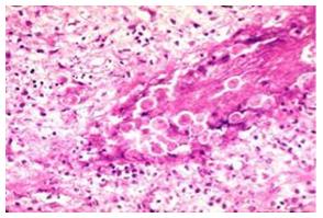 Figure 5: Megakaryocyte in liver FNA in an ALL patient.