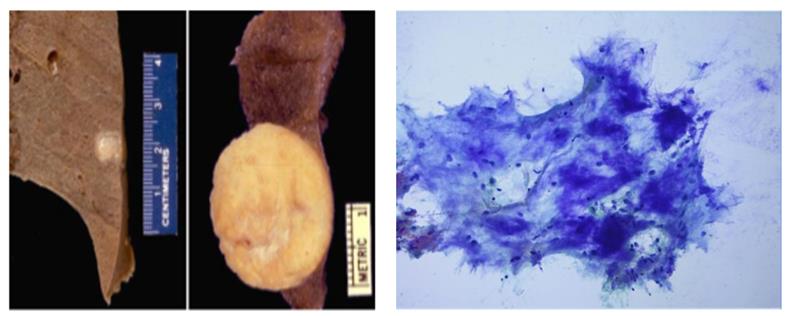 Figure 53: Immunocytochemistry of corresponding smear.