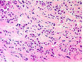 Figure 57: STAT6 positive cells in SFT.