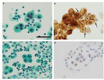 Figure 58: CD99 positivity in immunocytochemistry.