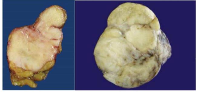 Figure 59: Thymic Neoplasms.