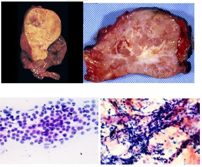 Figure 62: Ganglion cells with Schwann cell admix in ganglioneuroma.