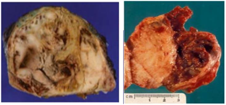 Figure 65: Lymhoblastic lymphoma vs DLBCL.