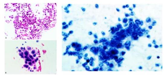 Figure 66: Large cell lymphoma anaplastic cells.