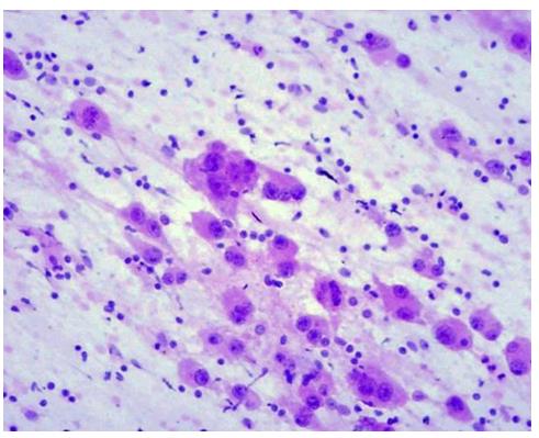 Figure 69: Angiofollicular lymphoid hyperplasia.