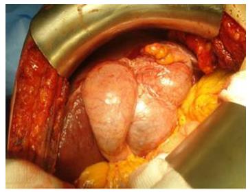 Figure 7: Liver cell adenoma.