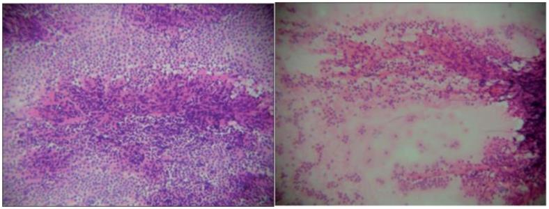 Figure 74: Nuclear hobnailing in cystic nephroma.