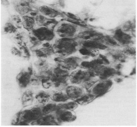 Figure 75: Corresponding tissue section shows hobnail epithelium lining cystic spaces.