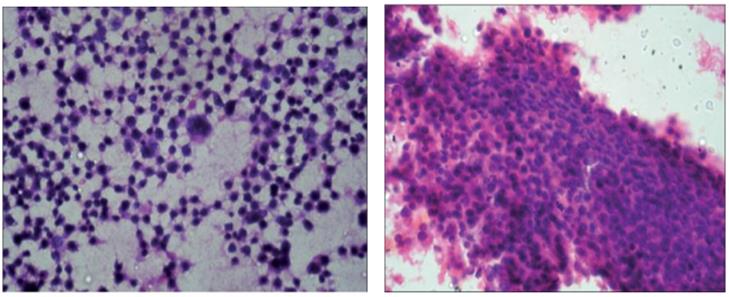 Figure 76: Gross picture of cystic nephroma.