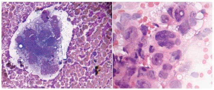 Figure 77: A typical macrophages in xanthogranulomatous nephritis in air dried smear showing prominent nucleoli and irregular nuclear contour.