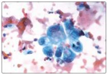 Figure 78: All the three components of angiomyolipoma.