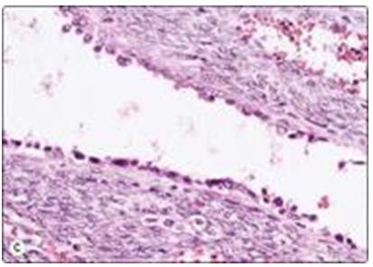 Figure 79: Left -A cluster of cells in FNAB, Smear from clear cell carcinoma showing fine cytoplasmic vacuolation mostly due to lipid.