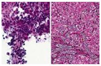Figure 8: Malignant hepatocytes in HCC (prominent nucleoli is not a feature of HCC).