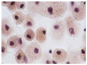 Figure 80: Left-Aspiration smear from a papillary renal cell carcinoma showing a papillary structure composed of fibrovascular cores covered by tumor cells.