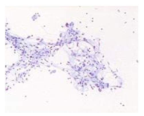Figure 82: Loosly arranged clusters of oncocytic cells having bland monomorphic nuclei and fine granular eosinophilic cytoplasm. Collecting duct type of RCC: Single cells of glandular or intermediate type with malignant nuclear features. A tubular or papillary arrangement may be present (Figure 83).