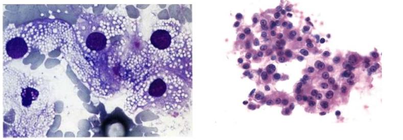 Figure 84: Histopathological picture of Xp11.2 translocation RCC (melanotic variant).