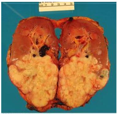 Figure 87: A feature of metanephricadenoma, optical clearing and grooving of nuclei.