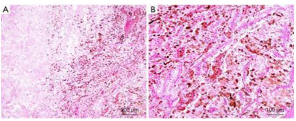Figure 89: Monomorphic blastemal cells in geimsa with clear nuclear moulding and cytoplasmic remnant.