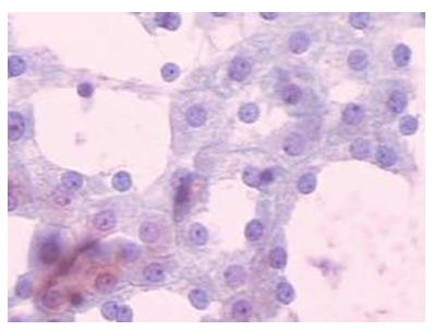 Figure 9: Malignant ductal cells.