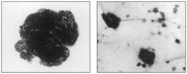 Figure 90: Gross picture of transitional cell ca. of renal pelvis.
