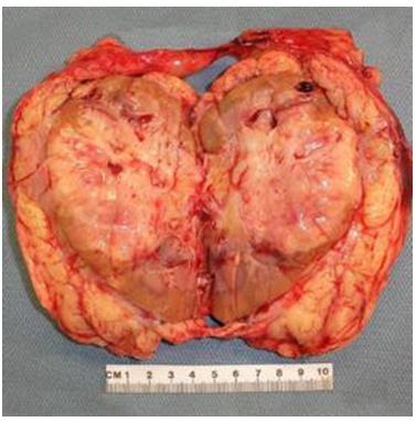 Figure 95: Cystic lymphangioma in deep thoracic region shows clear lymphatic and angiomatous vessels.