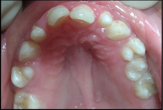 Figure 1: Clinical photograph showing microdontia of maxillary permanent lateral incisor in a patient with Down syndrome.