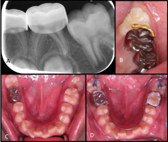 Figure 10: Periapical radiographs demonstrating ectopically erupting mandibular left first permanent molar due to uncrimped distal margin of stainless- steel crown on second primary molar (A) and clinical photograph showing use of brass wire to upright (unlock) ectopically erupting first permanent molar (B). Clinical Photographs of ectopically erupting mandibular second permanent molars (C) after placement of a bilateral Halterman’s appliance for uprighting of second molars (D).
