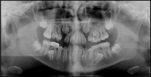 Figure 11: Panoramic radiograph demonstrating impaction of both maxillary canine and resorption of permanent maxillary lateral incisor roots. Distally displaced mandibular second premolars can also be noted on the radiograph.