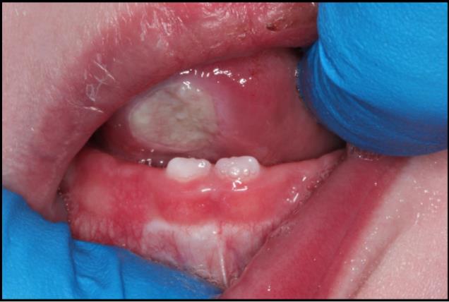 Figure 12: Clinical photograph demonstrating neonatal teeth with ulceration on the ventral aspect of the tongue (Riga-Fede disease).