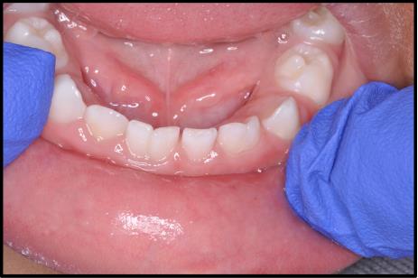 Figure 14: Clinical photograph demonstrating gemination of mandibular right central and left lateral primary incisors.