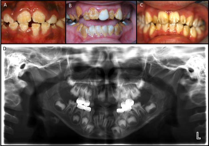 Figure 15: Clinical photographs demonstrating Amelogenesis Imperfecta (AI) types: hypocalcified (A), hypomineralized (B) and hypomaturation (C) with panoramic radiograph (D) demonstrating no discernable radiodensity of enamel.