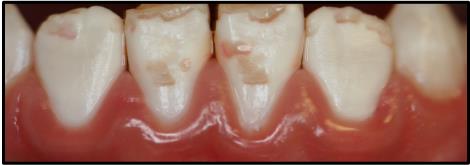 Figure 16: Clinical photograph showing localized enamel hypoplasia on facial surface of mandibular permanent central and lateral incisors.